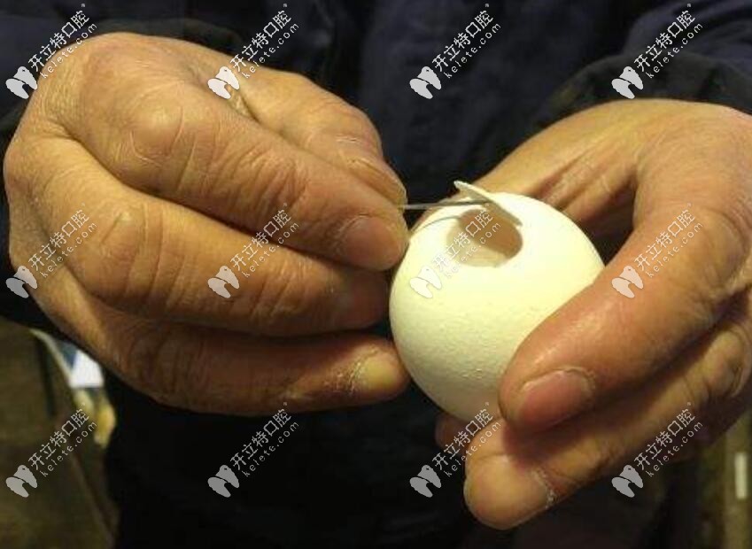 上頜竇底骨增量手術（俗稱上頜竇底外/內提升術）