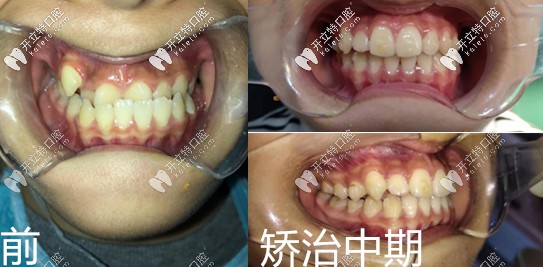 <!--<i data=20240703-sp></i>-->口腔醫(yī)院兒童地包天矯正真人案例