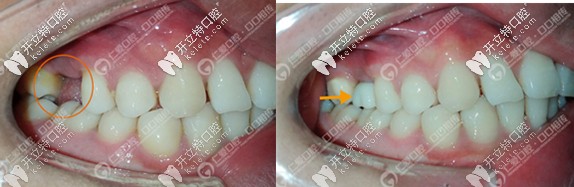 案例集:原來有挺多年輕人種價格便宜的登騰和奧齒泰種植牙
