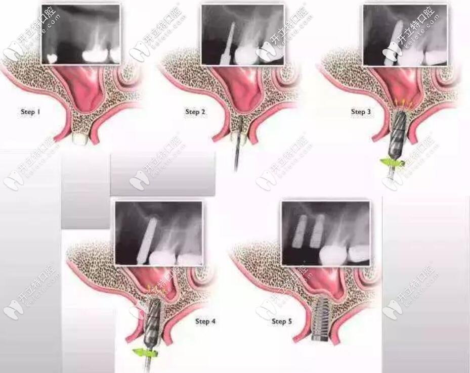 上頜竇提升手術的全過程