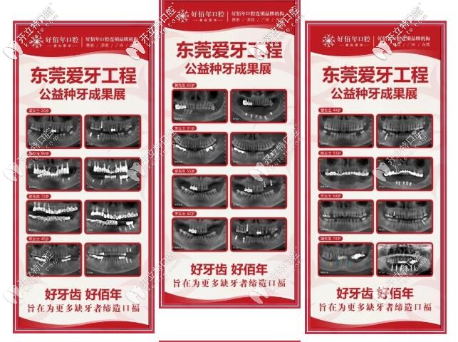 東莞好佰年口腔 種牙公益成果展示