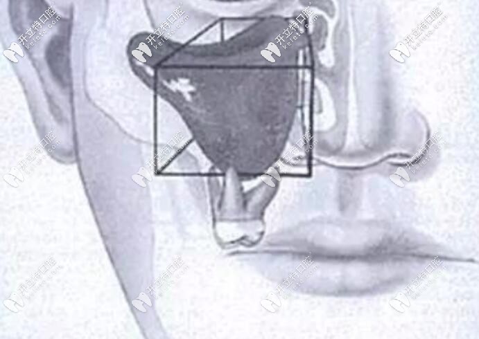 種植牙上頜竇穿透了會自愈嗎