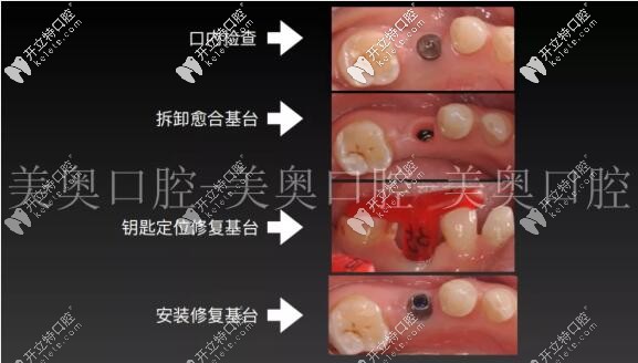種植牙術(shù)后拆卸基臺 種植牙術(shù)后拆卸基臺