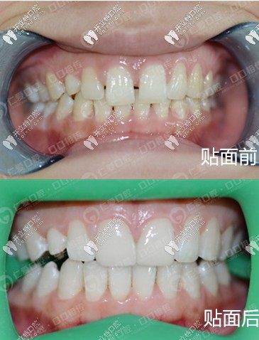 門牙稀疏美加超薄瓷貼面真人案例 <!--<i data=20240703-sp></i>-->口腔