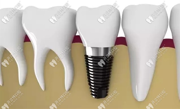 劉果生主任擅長各種復(fù)雜的口腔種植修復(fù) 劉果生主任擅長各種復(fù)雜的口腔種植修復(fù)