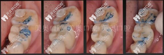 無錫美奧種植牙調(diào)頜 無錫美奧種植牙調(diào)頜