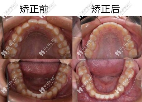  昆明美奧正畸案例前后對比圖