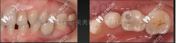 單顆種植牙圖片 單顆種植牙圖片