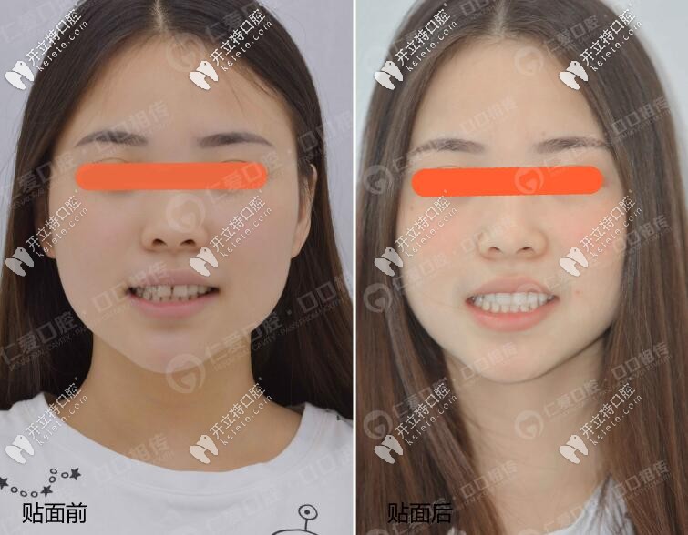 牙齒不齊武漢美加超薄瓷貼面修復體驗,超nice牙貼面醫(yī)生推薦