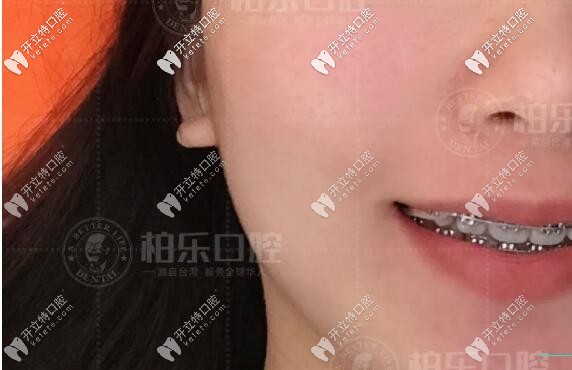 南寧柏樂口腔金屬自鎖牙齒矯正