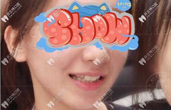 南寧柏樂口腔牙齒不齊案例