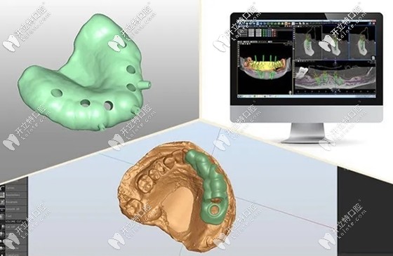 岑燕梅醫(yī)生淺談MAC智能種植牙