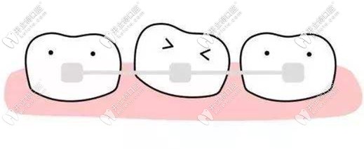 矯正牙齒可以改善牙縫大