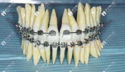 直絲弓矯正技術(shù) 直絲弓矯正技術(shù)