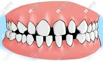 牙縫變大可以自己縮小么？教你讓牙縫變小的小技巧