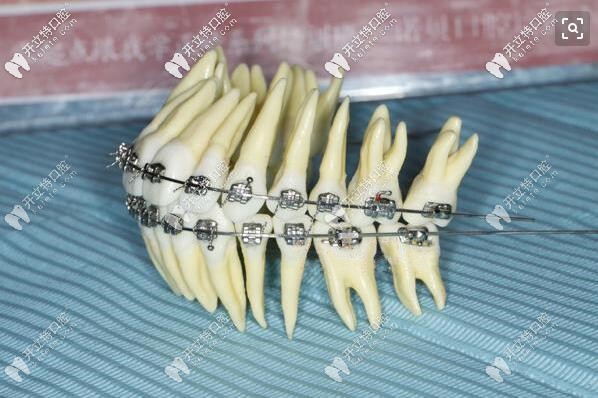 MBT直絲弓矯正圖片