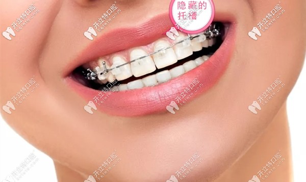 戴冰晶半隱形牙套的禁忌事項