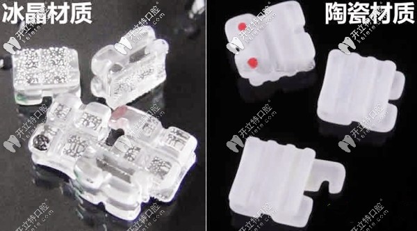 冰晶牙套矯正的價格