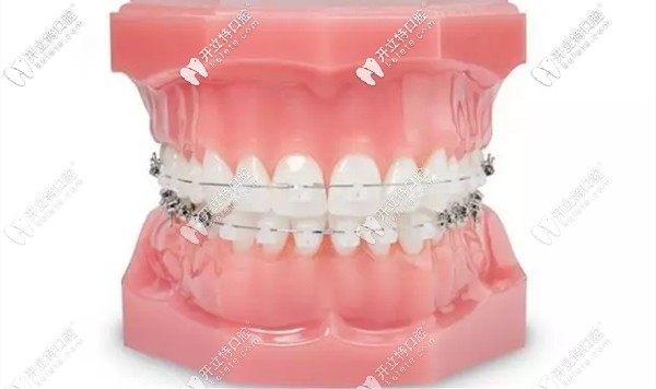 冰晶托槽有是國產(chǎn)和進(jìn)口之分的