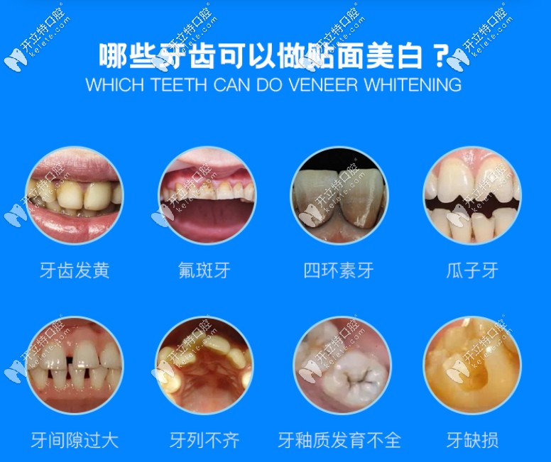 那些牙齒可以做貼面美白修復(fù)