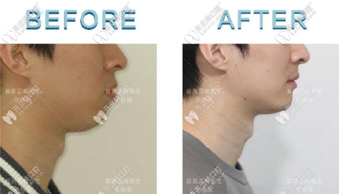 來看看張棟梁矯正效果怎么樣 來看看張棟梁矯正效果怎么樣