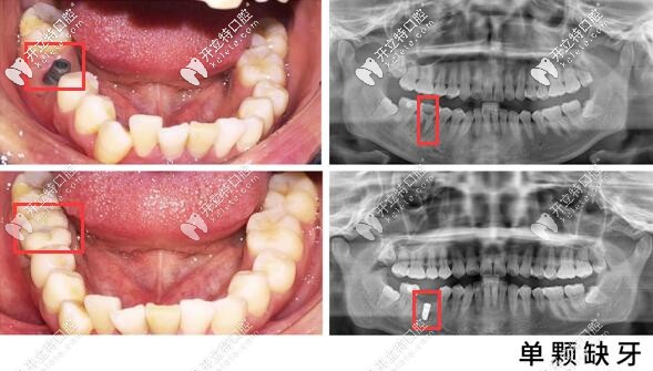 昆明美奧口腔單顆牙種植案例