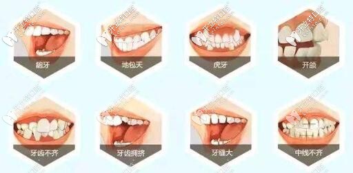 球面自鎖托槽矯正適合骨性嗎