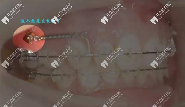 牙齒矯正過(guò)程中打支抗釘
