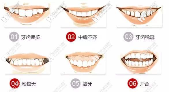 哪些人適合做牙齒矯正 哪些人適合做牙齒矯正