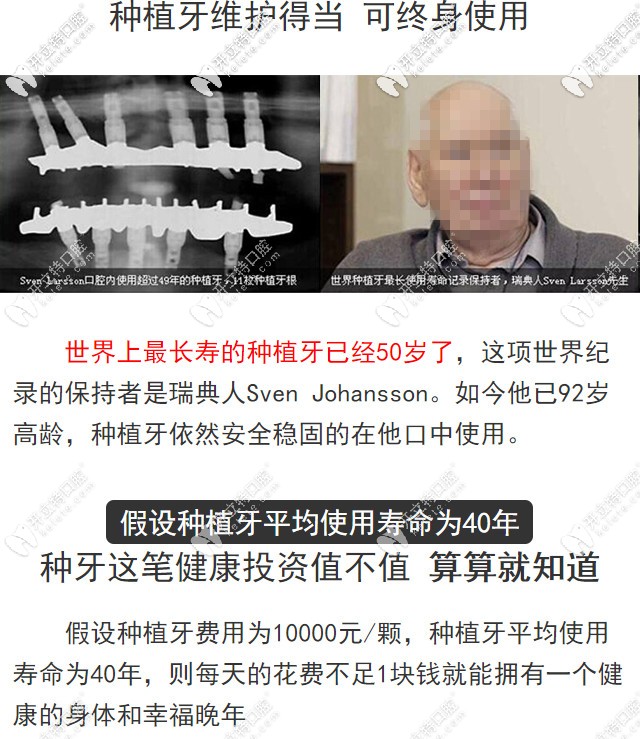 種植牙的壽命有多長(zhǎng)