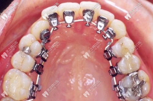 對(duì)舌側(cè)隱形矯正的介紹
