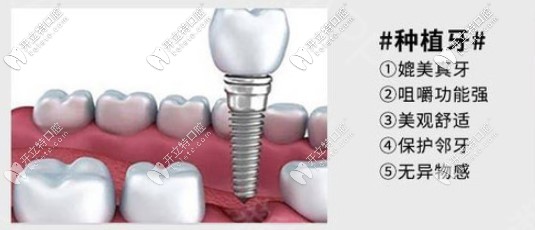種植牙的優(yōu)勢