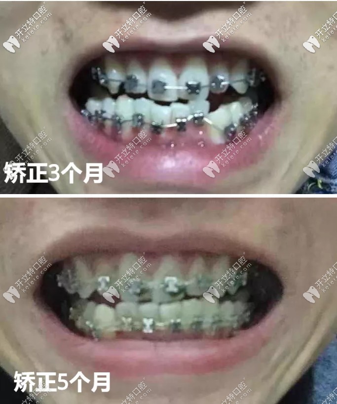 東莞固德口腔矯正牙齒怎么樣 東莞固德口腔矯正牙齒怎么樣