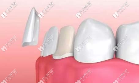 四環(huán)素牙采用牙貼面