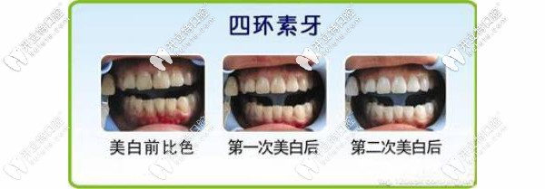 四環(huán)素牙漂白效果