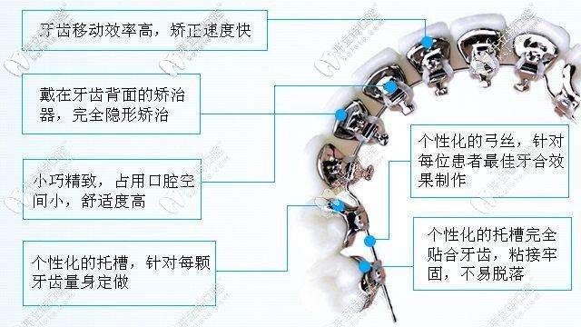 舌側(cè)矯正的特點 
