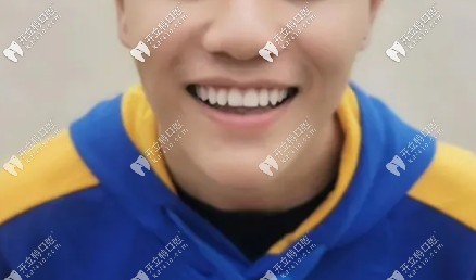 深覆頜能矯正嗎?附上我從固德口腔帶鋼牙套一年后的對比圖