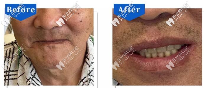 北京中諾口腔做吸附性義齒案例前后效果對比
