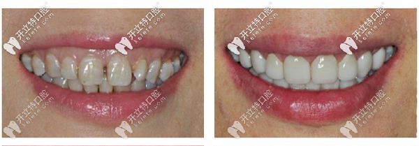 重度四環(huán)素牙漂白