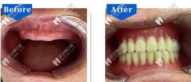 全口吸附義齒修復前后對比照