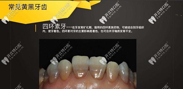 做四環(huán)素牙牙齒漂白多少錢？做出來不知道效果好不好？