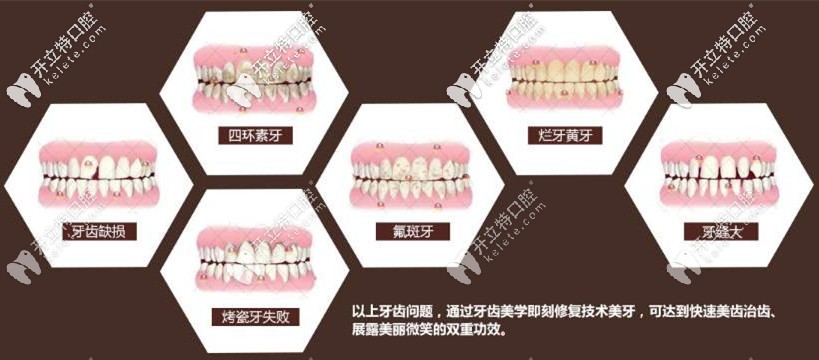 前牙美學(xué)修復(fù)適應(yīng)癥