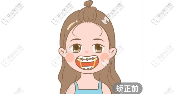 牙齒矯正前