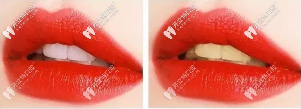 黃牙與白牙的效果對比圖