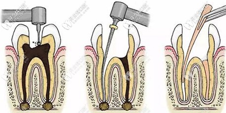 根管治療的流程圖