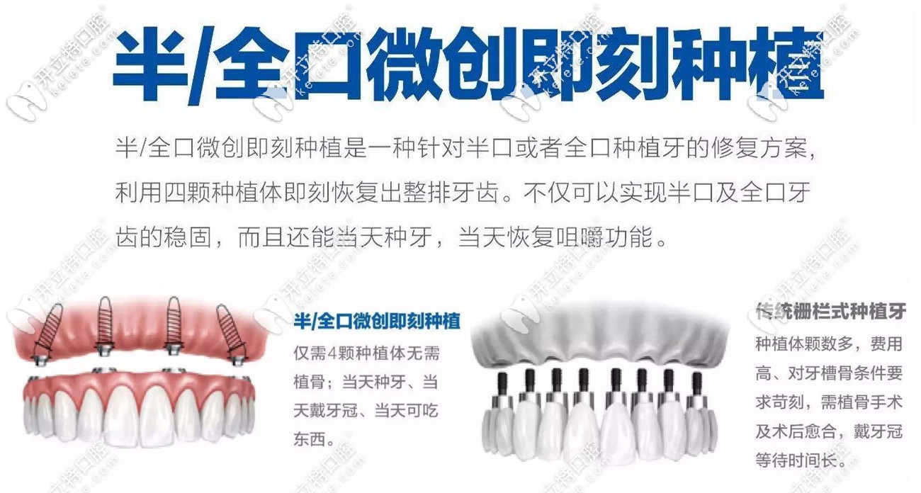 半/全口微創(chuàng)即刻種植技術(shù)的特點(diǎn)