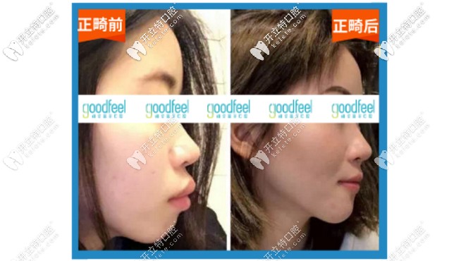 格倫菲爾牙齒矯正案例