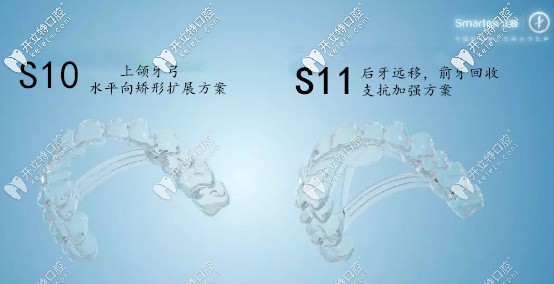 S10、S11牙弓重塑隱形技術(shù)