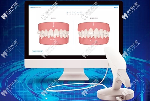 時(shí)代天使3shape 3D口掃儀