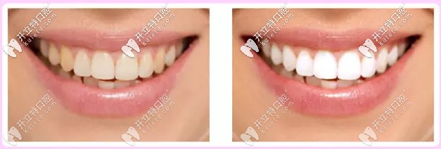 皓齒美白效果